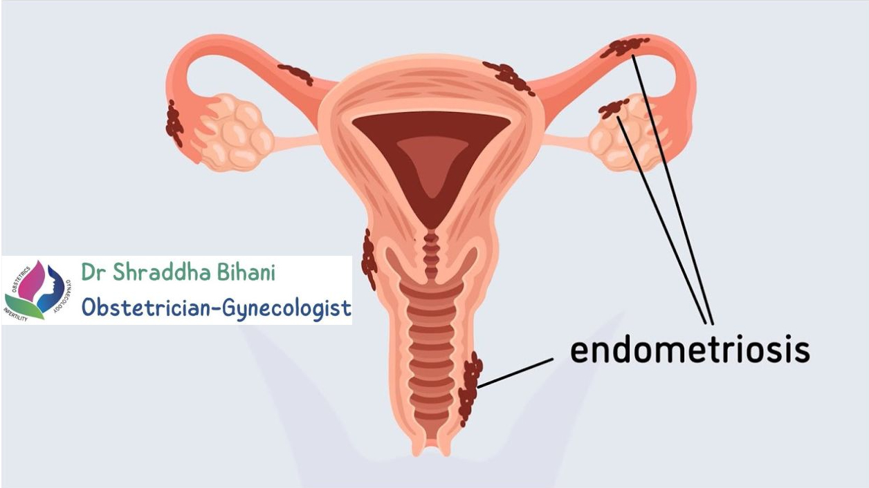 Illustration of the female reproductive system showing endometriosis, highlighting specialized care by Dr. Shraddha Bihani in Indore.