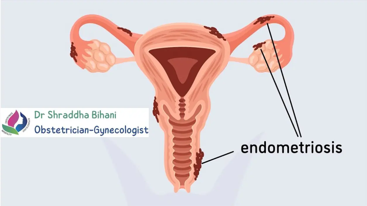 Endrological System Expert Endometriosis Treatment in Indore | Best Gynecologist
